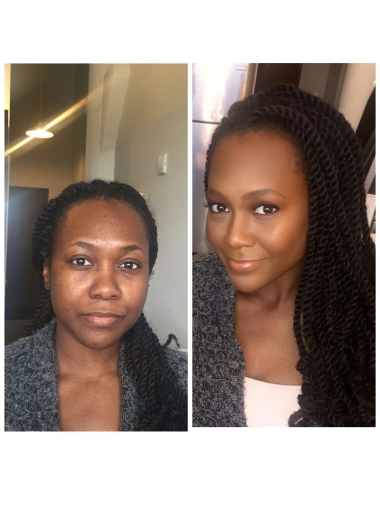 Carotone Before & After Top Results of Carotone OBS Cosmetic Blog