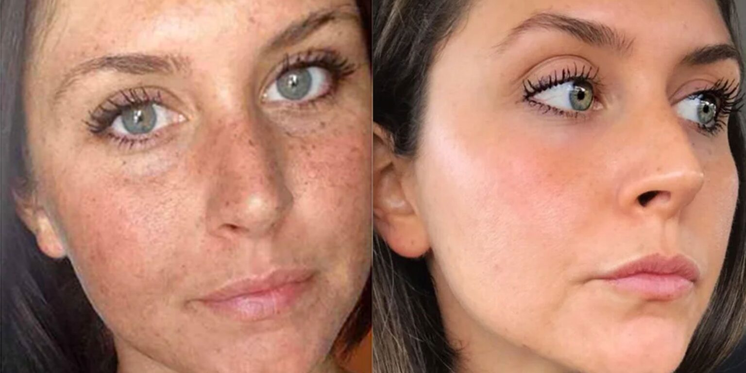 Caro Light Before & After Top Results of Carolight OBS Cosmetic Blog