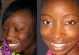 African Formula Before & After
