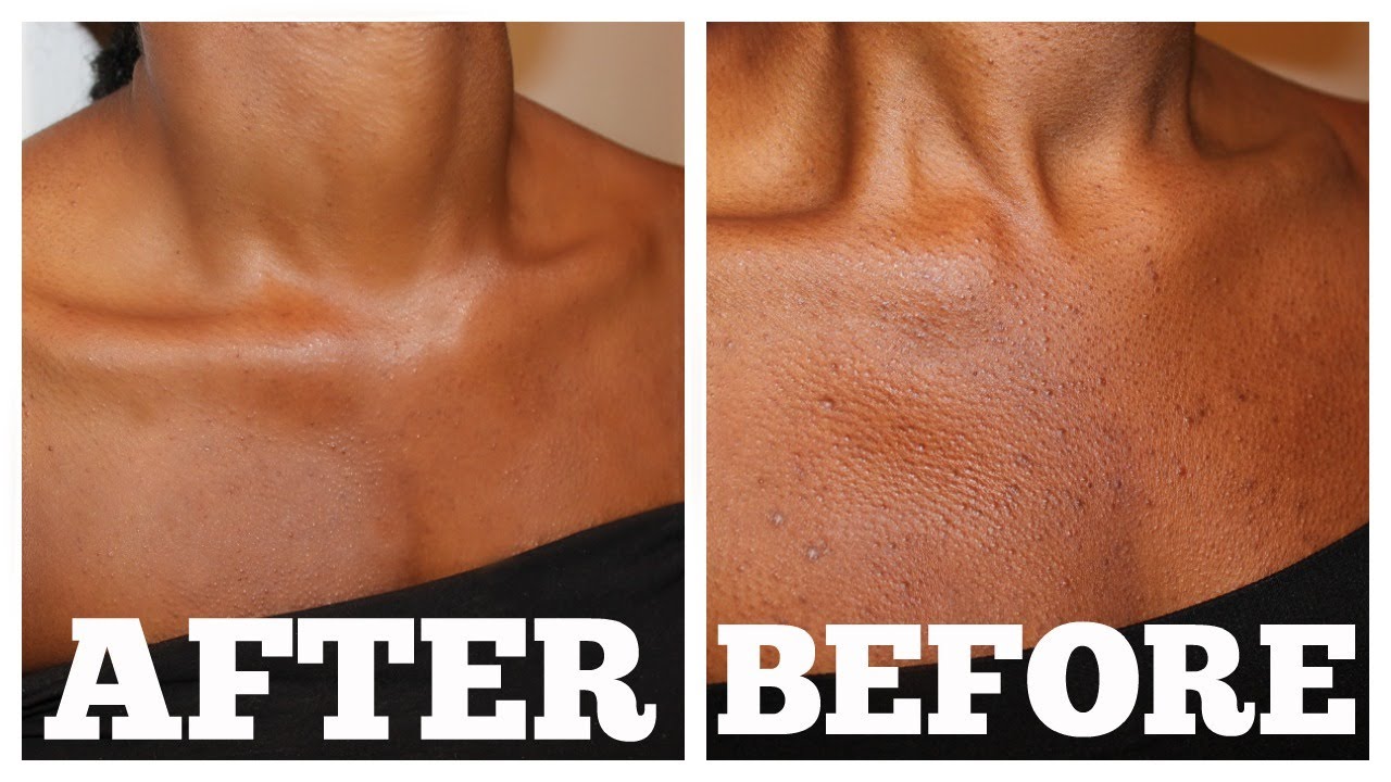 Carotone Before & After Top Results of Carotone OBS Cosmetic Blog