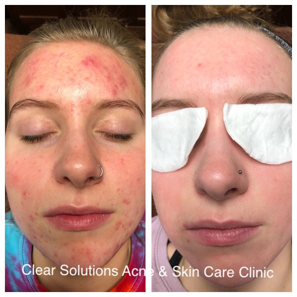 Clinic Clear Before & After
